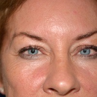 Before and After Laser and Light Skin Treatments
