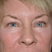 Before and After Laser and Light Skin Treatments