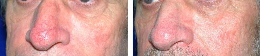 VariLight laser treatments