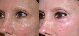 Chemical Peel Before and After | New Albany IN, St. Matthews KY