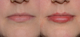 Lip Enhancement Before and After | New Albany IN, St. Matthews KY