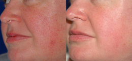 Laser Procedures Before and After | New Albany IN, St. Matthews KY