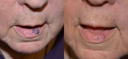 Laser Procedures Before and After | New Albany IN, St. Matthews KY