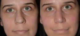 Nose Reshaping Before and After | New Albany IN, St. Matthews KY