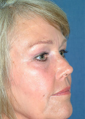 Forehead & Brow Lift After