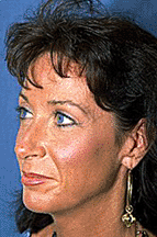 Cheek Augmentation Before Cheek Augmentation Before