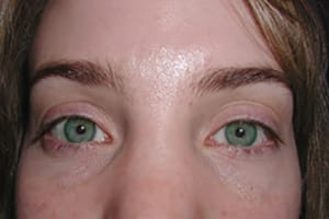 Chemical Peel Before, New Albany, IN and Louisville, KY