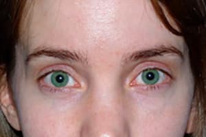 Chemical Peel After, New Albany, IN and Louisville, KY