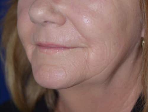 Chemical Peel After, New Albany, IN and Louisville, KY