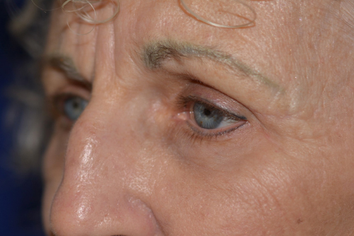 Chemical Peel After, New Albany, IN and Louisville, KY