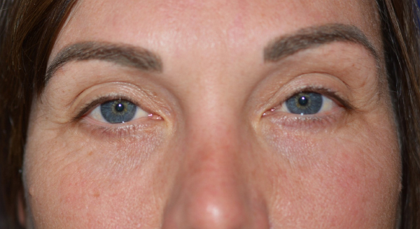 Chemical Peel Before, New Albany, IN and Louisville, KY