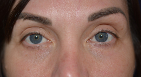 Chemical Peel After, New Albany, IN and Louisville, KY