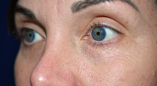 Chemical Peel Before, New Albany, IN and Louisville, KY