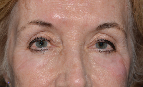 Chemical Peel After, New Albany, IN and Louisville, KY