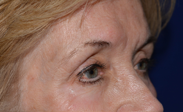 Chemical Peel After, New Albany, IN and Louisville, KY