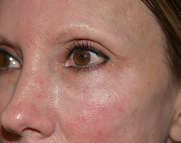 Chemical Peel Before, New Albany, IN and Louisville, KY