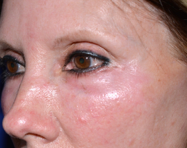 Chemical Peel After, New Albany, IN and Louisville, KY