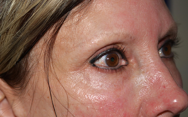Chemical Peel Before, New Albany, IN and Louisville, KY