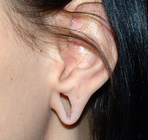 Ear Reshaping Before