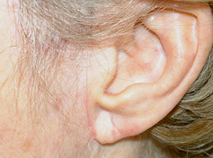 Ear Reshaping Before