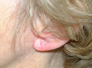 Ear Reshaping After