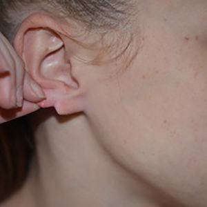 Ear Reshaping Before