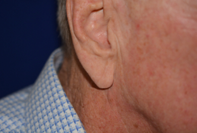 Ear Reshaping Before