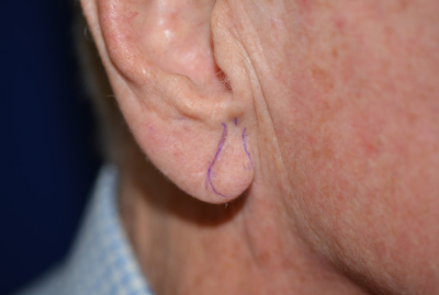 Ear Reshaping After