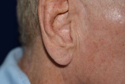 Ear Reshaping After