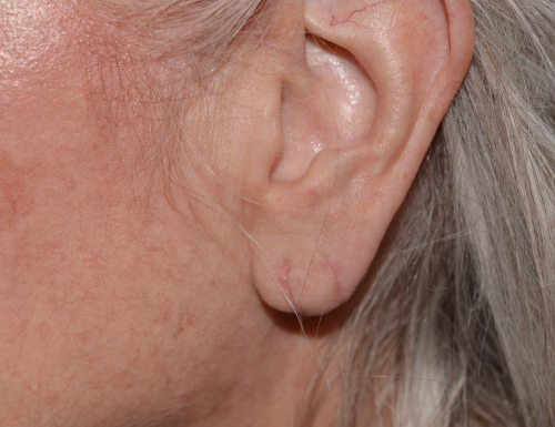 Ear Reshaping After