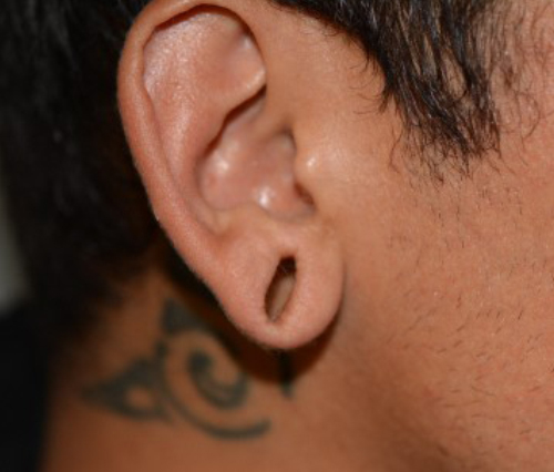 Ear Reshaping Before