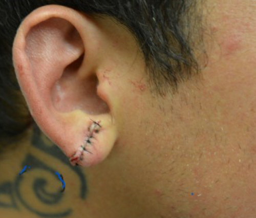 Ear Reshaping After