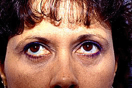 Eyelid Lift After