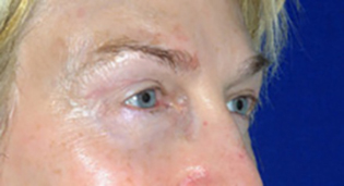 Eyelid Lift After