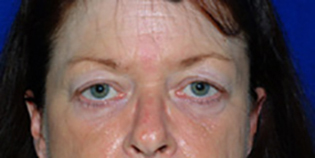 Eyelid Lift Before