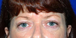 Eyelid Lift After