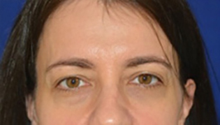 Eyelid Lift Before
