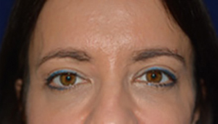 Eyelid Lift After