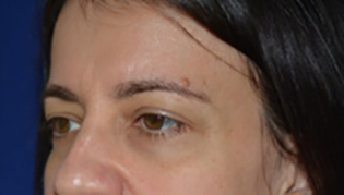 Eyelid Lift Before