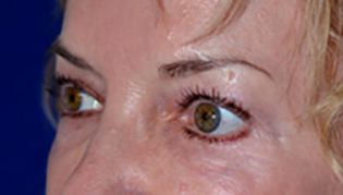 Eyelid Lift Before