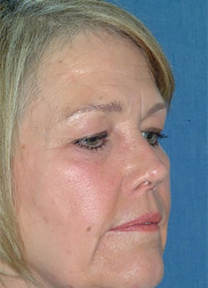Eyelid Lift Before
