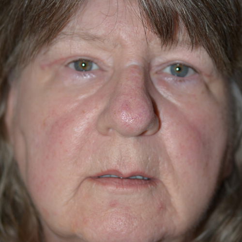 Eyelid Lift After