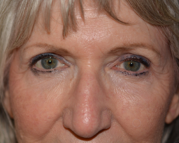 Eyelid Lift After