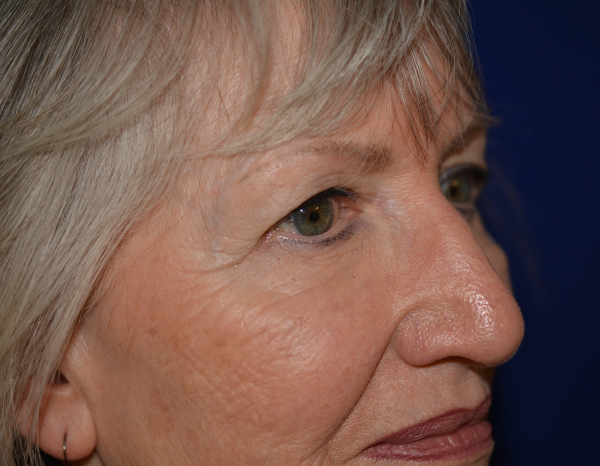 Eyelid Lift Before