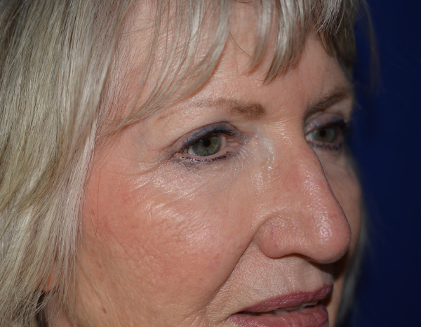 Eyelid Lift After