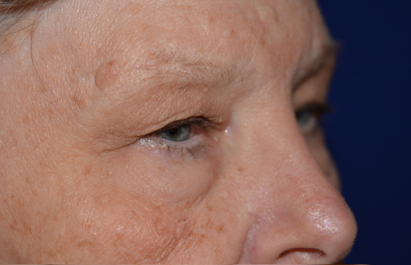 Eyelid Lift Before