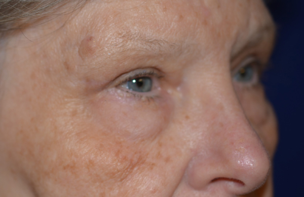 Eyelid Lift Before