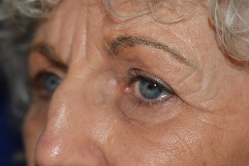 Eyelid Lift Before