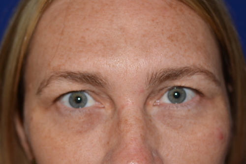 Eyelid Lift Before