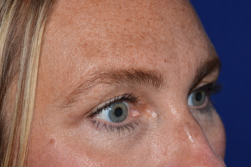 Eyelid Lift Before